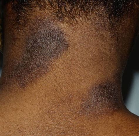 Plaque psoriasis is most common on the elbows, knees, and scalp. . Pictures of hiv rashes on dark skin